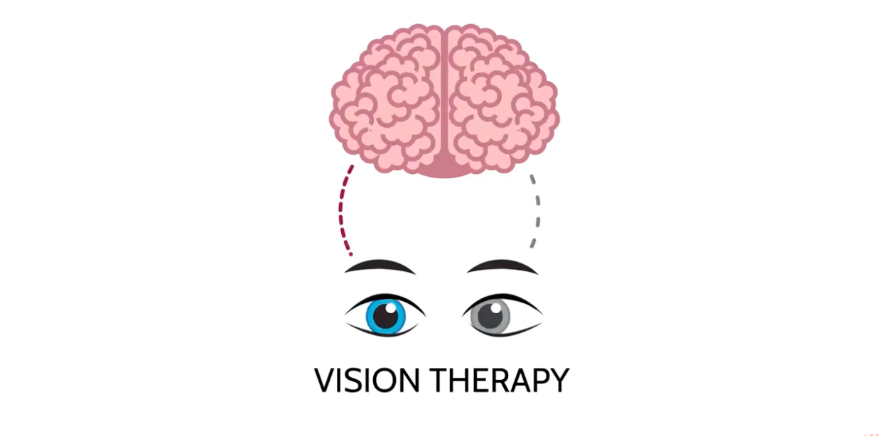 AmblyoPlay Vision Therapy